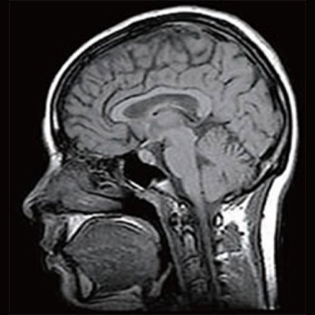 頭部のMRI 画像