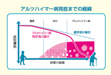 アルツハイマー病発症までの経緯 画像